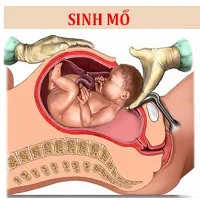 2 mặt lợi - hại của sinh mổ so với sinh thường