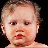 Làm gì khi con trẻ mắc quai bị?