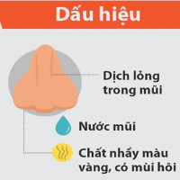 7 dấu hiệu cảnh báo bạn bị viêm xoang