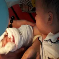 Sơ cứu đúng cách khi gặp tai nạn làm dập nát, đứt lìa chi