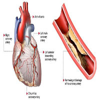 Thủ phạm gây nhồi máu cơ tim