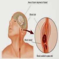 Làm thế nào để không chết oan vì nhầm đột quỵ với trúng gió?