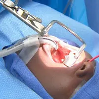 Biến chứng nguy hiểm có thể xảy ra khi cắt amidan
