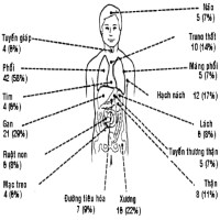 Thủ phạm gây ung thư amidan bạn cần tránh