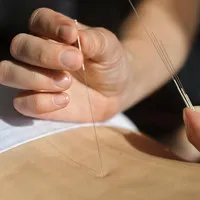 Châm cứu thật sự "có tác động" đối với cơ thể người