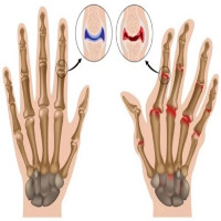 Gene gây bệnh viêm khớp từng giúp người cổ đại sống sót qua kỉ Băng Hà