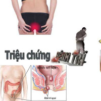 Các cấp độ của bệnh trĩ, nguyên nhân, cách phòng tránh và chế độ ăn uống