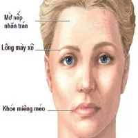 Cảnh giác bệnh liệt nửa mặt dễ xảy ra vào mùa đông xuân