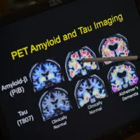 Có thể "trị" bệnh Alzheimer mà không cần đến thuốc