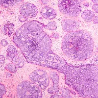 Phát hiện 110 gene mới gây ung thư vú