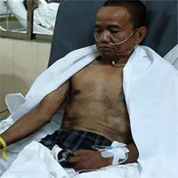 Bỏng đường hô hấp nguy hiểm như thế nào?