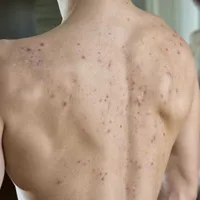 Mọc mụn trứng cá cả ở lưng là biểu hiện cho thấy cơ thể đang bị làm sao?