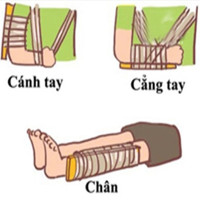 Hướng dẫn sơ cứu đúng cách cho trẻ bị gãy xương