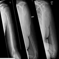 Căn bệnh kỳ lạ khiến xương bệnh nhân "bốc hơi" ngay trước mắt bác sĩ