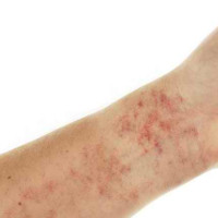 12 dấu hiệu cảnh báo bệnh lupus ban đỏ