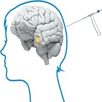 Dao laser đốt tế bào ung thư não lần đầu tiên được sử dụng ở Anh