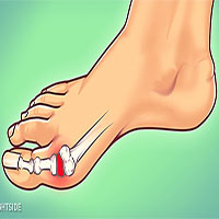 Cách hạn chế những cơn đau kinh khủng do bệnh gout gây ra