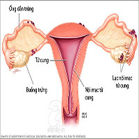 Lạc nội mạc tử cung là bệnh gì? Có nguy hiểm không?