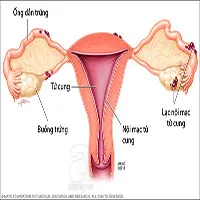 Lạc nội mạc tử cung là bệnh gì? Có nguy hiểm không?