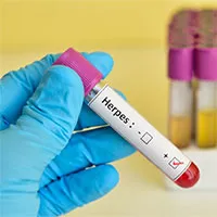Virus Herpes có thể dẫn đến rối loạn lưỡng cực, trầm cảm