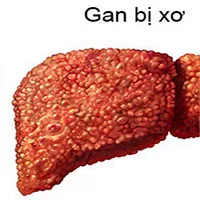 Bệnh xơ gan là gì? Ai dễ bị xơ gan nhất?