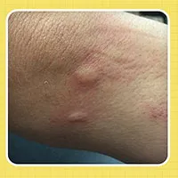 Đọc luôn để nắm được cách "soi" vết cắn, biết ngay con gì đốt
