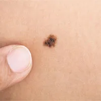 Một vắc xin ung thư cho hiệu quả 100% trong thử nghiệm trên chuột