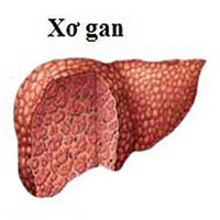 Xơ gan có mấy giai đoạn? Xơ gan cấp độ f1, f2, f3, f4 là gì?