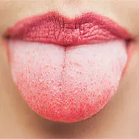 Dấu hiệu cảnh báo ung thư lưỡi