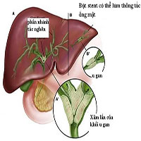 Ung thư đường mật - nguyên nhân, triệu chứng và cách điều trị