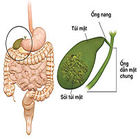 Cảnh báo ung thư đường mật di căn qua gan