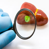 Bệnh polyp túi mật - Nguyên nhân, triệu chứng và cách điều trị