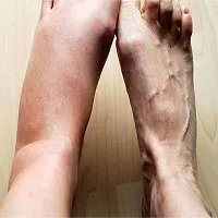 Tại sao cơ thể lại sưng khi bị viêm?