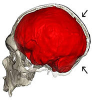 Những người đầu hơi bẹp là do gene di truyền của người Neanderthal