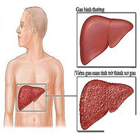 Xơ gan cổ trướng là gì? Triệu chứng, chẩn đoán và điều trị