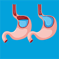 Trào ngược dạ dày thực quản là gì?