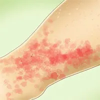 Cách điều trị đốm xuất huyết