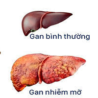 Gan nhiễm mỡ: Nguyên nhân, triệu chứng và cách điều trị