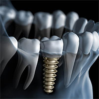 Cấy ghép răng implant là gì?