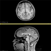 Tìm ra phương thức điều trị tốt nhất nhờ chuyển hình ảnh cắt lớp thành 3D