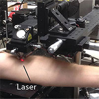 Công nghệ laser mới có thể tiêu diệt tế bào ung thư hắc tố