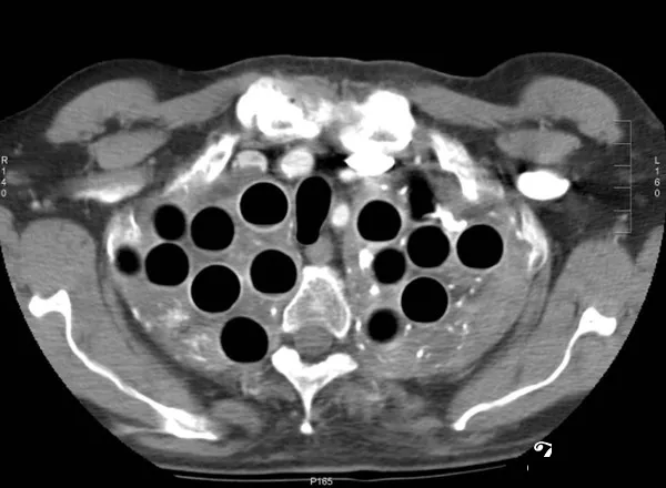Khuẩn tuberculosis