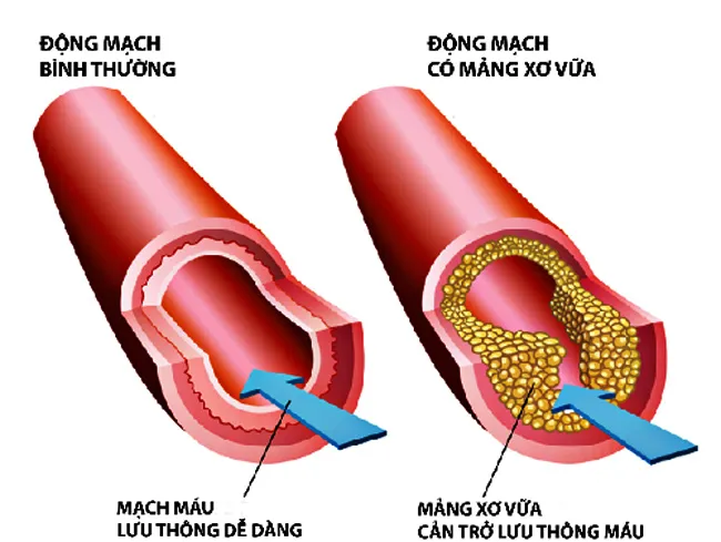 Rối loạn mỡ máu