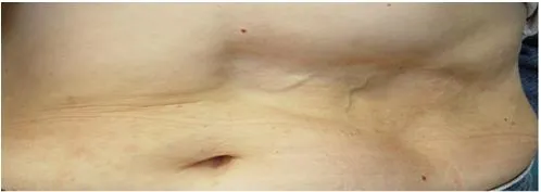 Chứng loạn dưỡng mỡ chi dưới