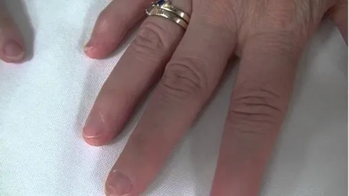 Hội chứng móng tay xương bánh chè (nail-patella syndrome)