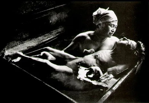 Nạn nhân bị nhiễm độc bởi chất thủy ngân ở khu vực Minamata đầu những năm 1950