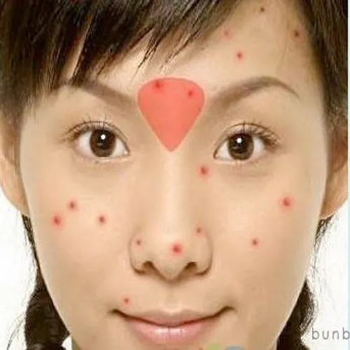 Mụn mọc giữa hai đầu lông mày và huyệt ấn đường