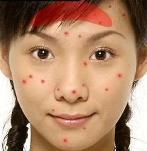 Mụn mọc ở trán