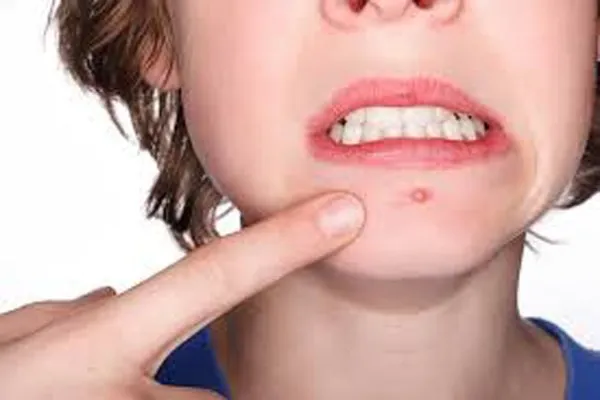 Mụn mọc ở cằm