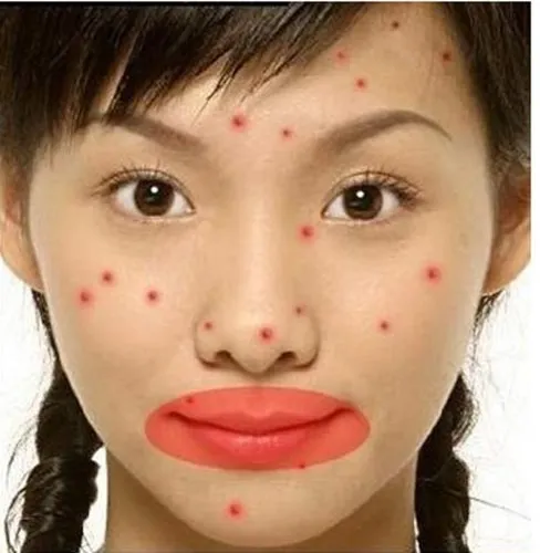 Mụn mọc ở vùng môi